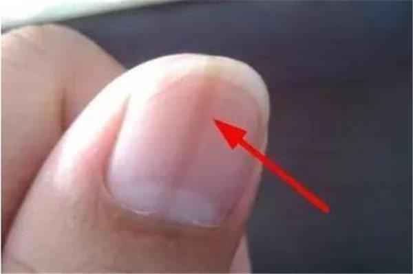 为什么指甲表面有明显的竖纹？是一种病吗？专家这样解释