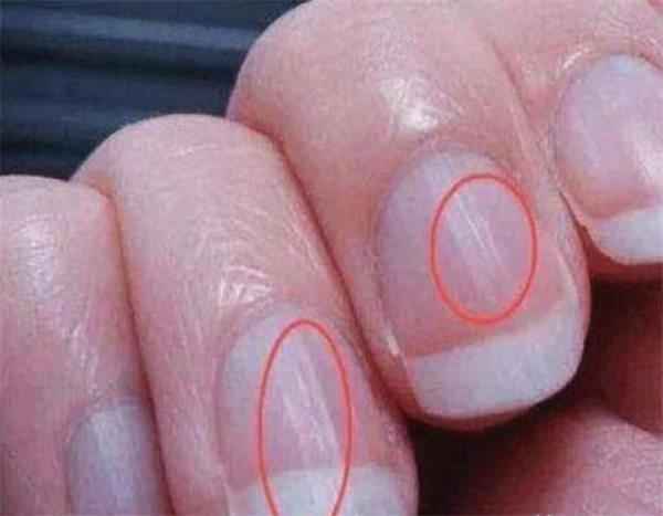 为什么指甲表面有明显的竖纹？是一种病吗？专家这样解释